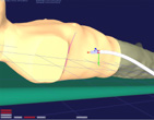 3-D Playback of chest insertion.